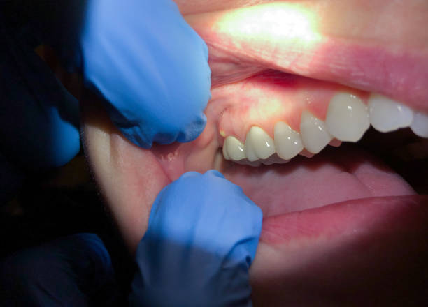 Best Knocked-Out Tooth (Avulsed Tooth) Treatment in Seabrook, SC